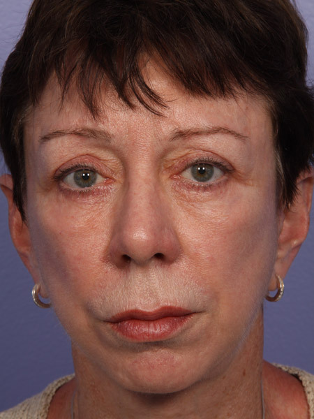 Eyelid Surgery before and after photo