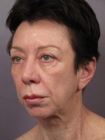 Eyelid Surgery Before and after photo