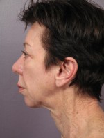 Eyelid Surgery Before and after photo