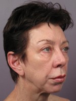 Eyelid Surgery Before and after photo