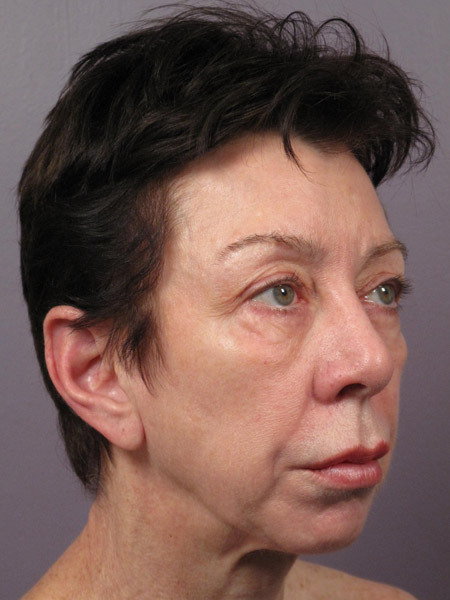 Eyelid Surgery before and after photo