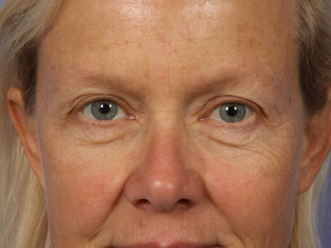 Eyelid Surgery before and after photo