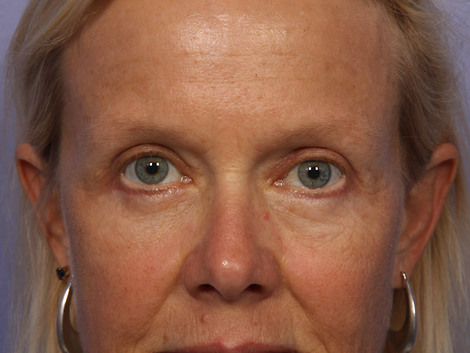 Eyelid Surgery before and after photo