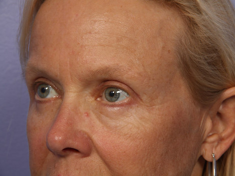 Eyelid Surgery before and after photo