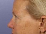 Eyelid Surgery Before and after photo