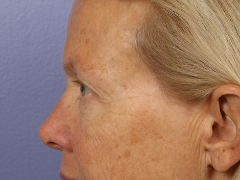 Eyelid Surgery before and after photo