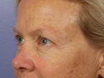 Eyelid Surgery Before and after photo