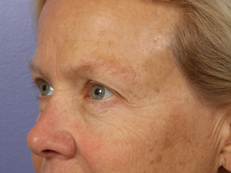 Eyelid Surgery before and after photo