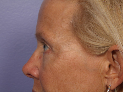 Eyelid Surgery before and after photo