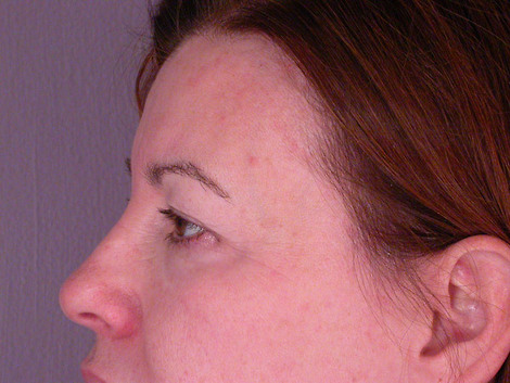 Eyelid Surgery before and after photo