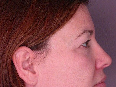 Eyelid Surgery before and after photo