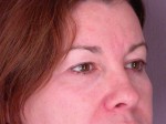 Eyelid Surgery