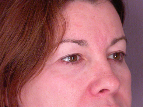 Eyelid Surgery before and after photo