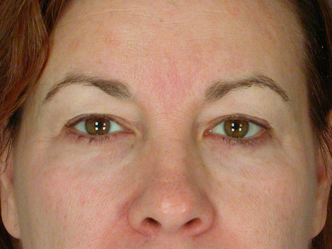 Eyelid Surgery before and after photo