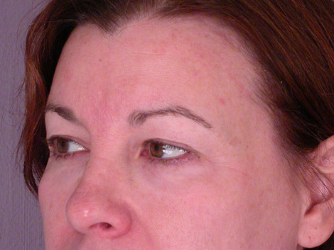 Eyelid Surgery before and after photo