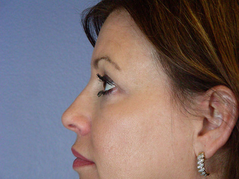 Eyelid Surgery before and after photo