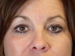 Eyelid Surgery Before and after photo