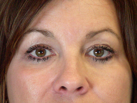 Eyelid Surgery before and after photo