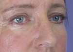 Eyelid Surgery Before and after photo