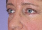 Eyelid Surgery Before and after photo