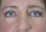 Eyelid Surgery