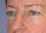 Eyelid Surgery