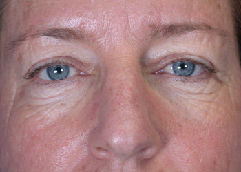 Eyelid Surgery before and after photo