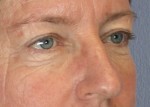 Eyelid Surgery Before and after photo