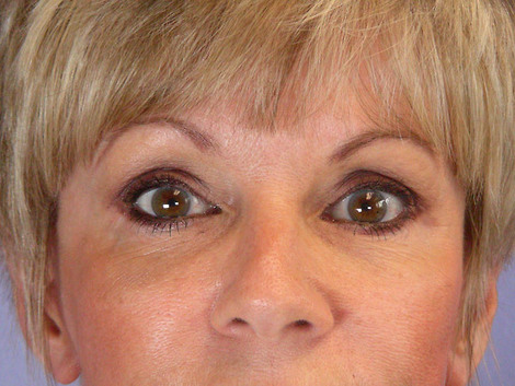 Eyelid Surgery before and after photo