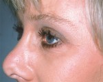 Eyelid Surgery