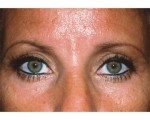 Eyelid Surgery