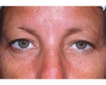 Eyelid Surgery