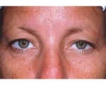 Eyelid Surgery Before and after photo