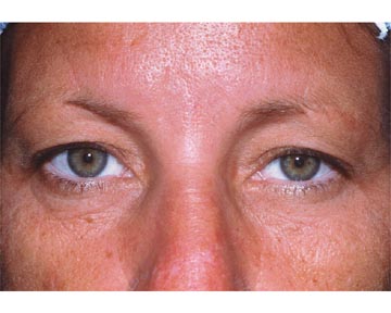 Eyelid Surgery before and after photo