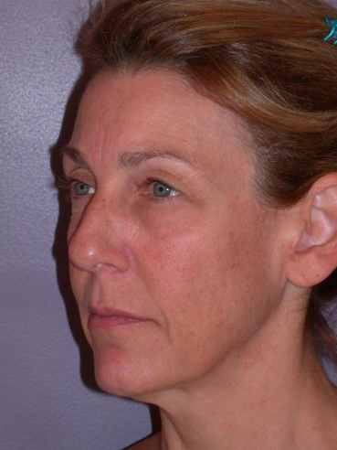 Eyelid Surgery before and after photo