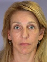 Eyelid Surgery