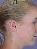 Ear Surgery Before and after photo