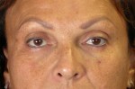 Injectable Fillers Before and after photo