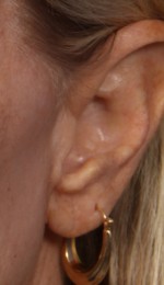 Ear Surgery Before and after photo