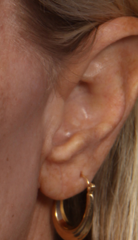 Ear Surgery before and after photo