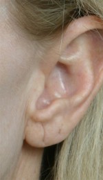 Ear Surgery Before and after photo