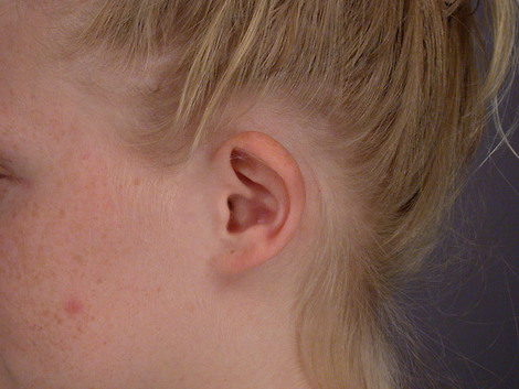 Ear Surgery before and after photo