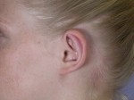 Ear Surgery Before and after photo