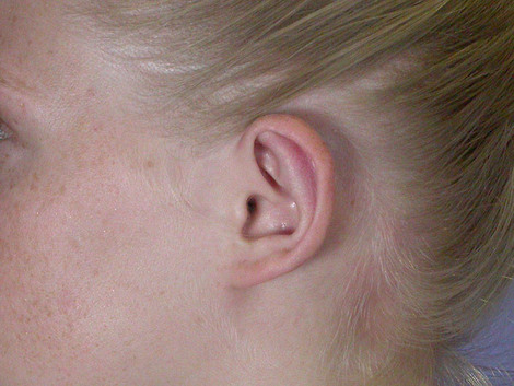 Ear Surgery before and after photo