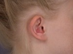 Ear Surgery Before and after photo