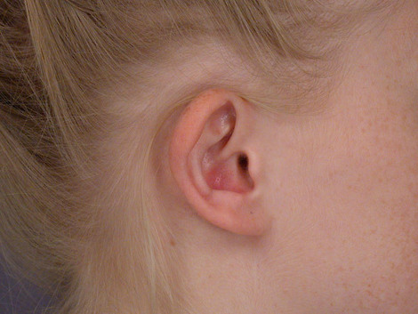 Ear Surgery before and after photo