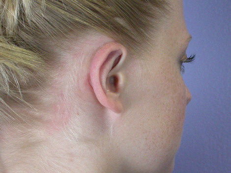 Ear Surgery before and after photo