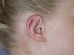 Ear Surgery Before and after photo