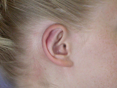 Ear Surgery before and after photo