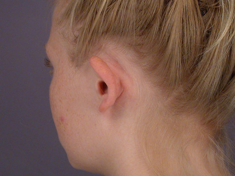 Ear Surgery before and after photo